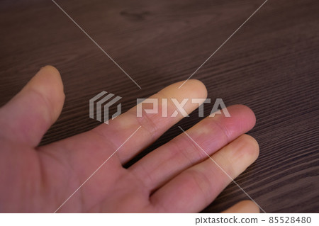 手指上佈滿雷諾症狀 手指上佈滿雷諾症狀 85528480