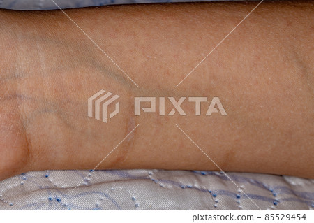 human pulse with allergy spots 85529454