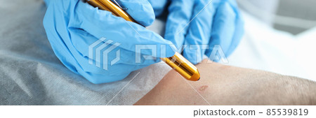 Laser removal of a mole on man neck in beauty salon 85539819
