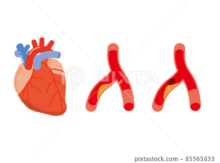 Heart and narrowed blood vessels Heart and narrowed blood vessels 85565833