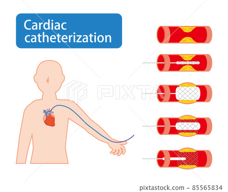 Image of cardiac catheterization 85565834