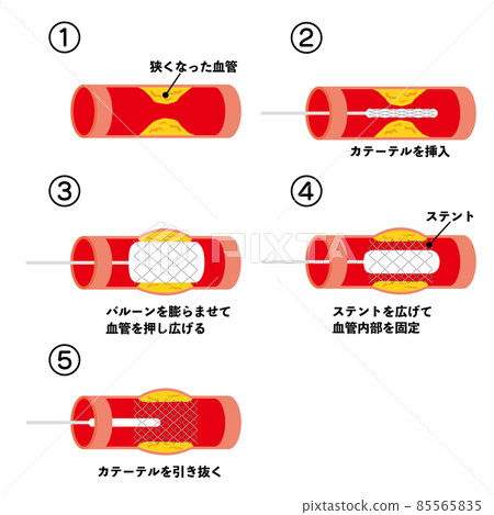 導管治療圖解說明 85565835