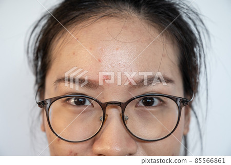 Close up of Asian woman having acne occur on her forehead. Conceptual shot of Acne and Problem Skin on female face. 85566861