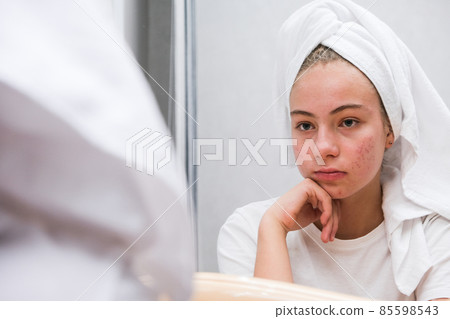 Acne. A sad teenage girl. Problematic skin in adolescents. Acne. A sad teenage girl. Problematic skin in adolescents. 85598543