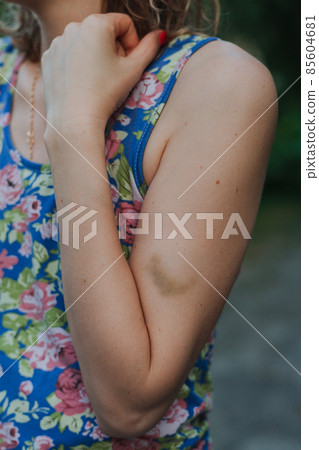 Bruise on woman arm. Injection bruises. Medical concept. 85604681