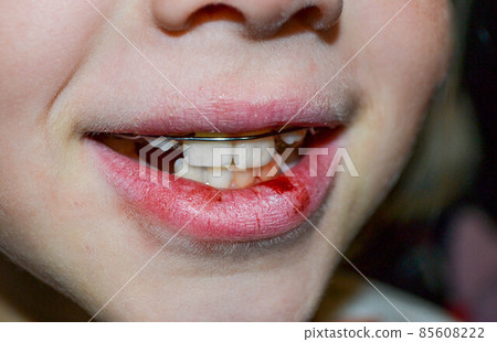 Dry and damaged lips of a girl Dry and damaged lips of a girl 85608222