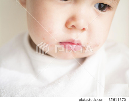 Image of eczema in the mouth of a half baby Image of eczema in the mouth of a half baby 85611870