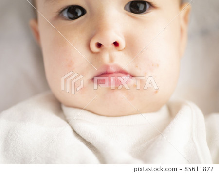 Image of eczema in the mouth of a half baby 85611872