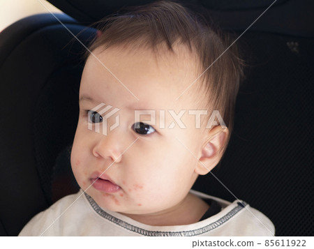 Image of eczema in the mouth of a half baby 85611922