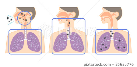 Illustration of the virus moving from the upper respiratory tract to the lower respiratory tract (nose, throat, lung chart) 85683776