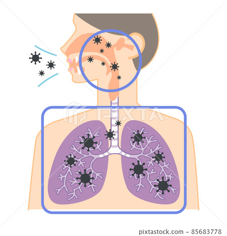 Invasion of the virus into the upper and lower respiratory tract (illustration of the nose, throat, and lungs) Invasion of the virus into the upper and lower respiratory tract (illustration of the nose, throat, and lungs) 85683778
