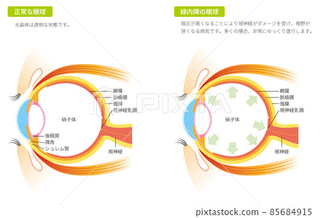 青光眼眼球（彩色） 85684915