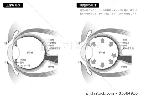 青光眼眼球（黑白） 85684916