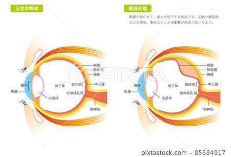 Eyeball with retinal detachment (color) Eyeball with retinal detachment (color) 85684917