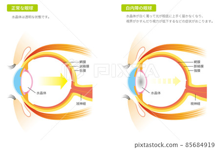 白內障眼球(彩色) 白內障眼球(彩色) 85684919