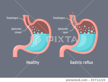 Esophageal gastric reflux acid indigestion. Gastrointestial stomach heartburn gerd gastric reflux Esophageal gastric reflux acid indigestion. Gastrointestial stomach heartburn gerd gastric reflux 85712220