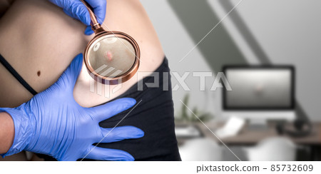 The doctor in medicsl gloves examines the growths on the woman's skin with a magnifying glass. Skin cancer. The doctor in medicsl gloves examines the growths on the woman's skin with a magnifying glass. Skin cancer. 85732609