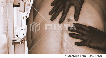 Doctor in medical gloves examines growths on a woman's skin. Skin cancer diagnostics. Doctor in medical gloves examines growths on a woman's skin. Skin cancer diagnostics. 85743683