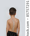 Scoliosis Spine Curve Anatomy, Posture Correction. Child with a deviated spine 85757291