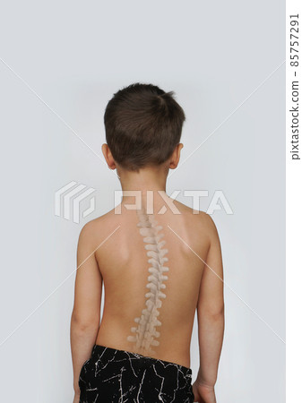Scoliosis Spine Curve Anatomy, Posture Correction. Child with a deviated spine 85757291