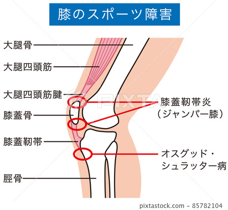 Knee joint explanatory diagram Sports injury Jumper knee Knee joint explanatory diagram Sports injury Jumper knee 85782104