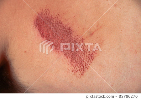 Close up of an abrasion wound in Caucasian skin Close up of an abrasion wound in Caucasian skin 85786270