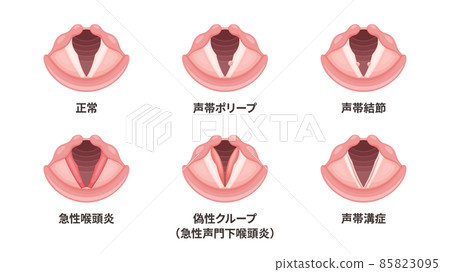 Illustration material set of laryngeal diseases 85823095