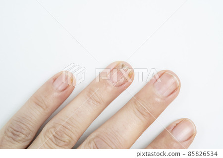 nail fungus infection on hand finger of white woman nail fungus infection on hand finger of white woman 85826534