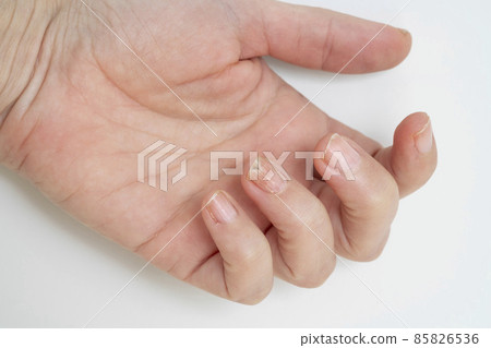 nail fungus infection on hand finger of white woman 85826536