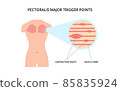 Pectoralis muscle trigger point. Myofascial release physical therapy, anatomy, medicine. For topics like sport, chronic pain, massage 85835924