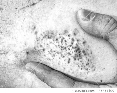 Embracing injured leg with painful place.  Doctor hand healing bloody  body 85854109