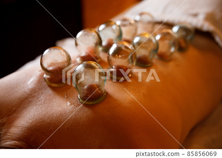 A young woman relaxes in a massage parlor. Vacuum cups of medical cupping therapy on woman back, close up, traditional chinese medicine. A young woman relaxes in a massage parlor. Vacuum cups of medical cupping therapy on woman back, close up, traditional chinese medicine. 85856069