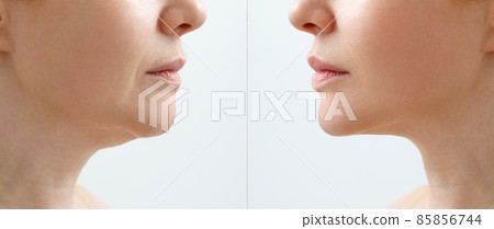 A close portrait of an aged woman before and after facial rejuvenation procedure. Correction of the chin shape liposuction of the neck. The result of the procedure in the clinic of aesthetic medicine. 85856744