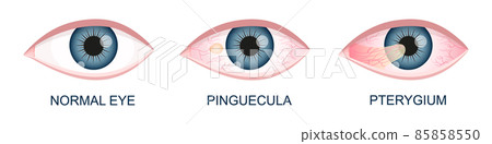 Eye healthy, with pinguecula and pterygium growing onto cornea. Conjunctival degeneration. Eye disease. Human organ of vision with pathology 85858550