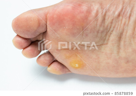 The back of a foot with warts 85878859