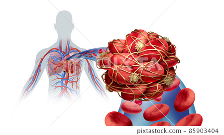 Pulmonary Embolism Illness Pulmonary Embolism Illness 85903404