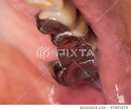 Metal crowns on the teeth in the mouth of a woman. Old harmful crowns causing allergies and diseases, macro 85905879
