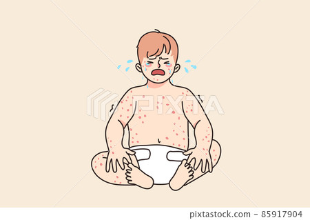 Unhappy baby crying suffer from eczema disease  85917904
