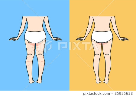 Woman in underwear after cellulite removal  85935638