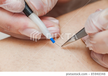 The process of permanent unwanted hair removal, using an electroepilation device and tweezers. The process of permanent unwanted hair removal, using an electroepilation device and tweezers. 85948348