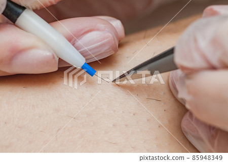 The process of permanent hair removal, removing unwanted hair using an electroepilation device and tweezers, close-up macro photography. The process of permanent hair removal, removing unwanted hair using an electroepilation device and tweezers, close-up macro photography. 85948349