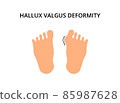 Foot with hallux valgus deformity. Bunion, problem, orthopedics. For topics like symptom, bone, podiatry 85987628