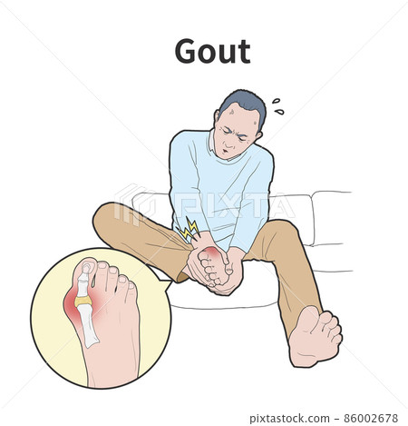 gout disease medical illustration 86002678