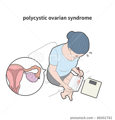 Polycystic Ovary Syndrome Disease Medical... - Stock Illustration ...