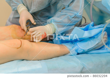 Surgeons suture their knees after liposuction. Close-up of plastic surgery to remove excess fat. 86032204