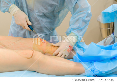 Cosmetic surgery liposuction. The process of removing fat on the legs of a fat woman. Without face, unrecognizable patient. 86032230