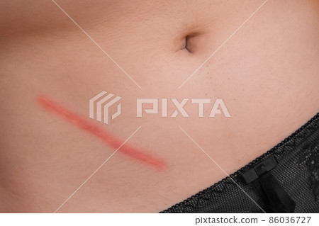 Body abdomen skin scar after removal of appendicitis surgery consequences of surgery, close-up 86036727