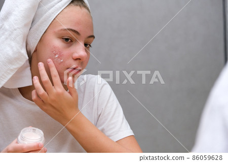 teenage girl . Acne. Care for problem skin teenage girl . Acne. Care for problem skin 86059628