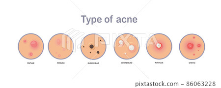 Acne concept. type of acne.papule,nodule,blackhead'whitehead,pustule,cystic.flat vector illustration. Acne concept. type of acne.papule,nodule,blackhead'whitehead,pustule,cystic.flat vector illustration. 86063228