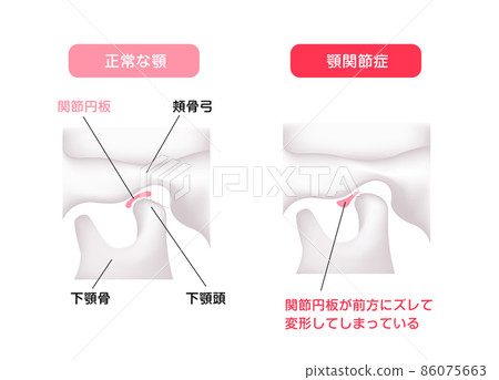 正常頜與顳下頜關節病頜/間接椎間盤病媒圖解的區別 86075663